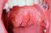 Oral candidiasis in AIDS patient