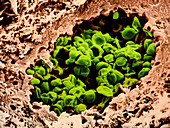 Coloured SEM of Pneumocystis carinii in AIDS lung