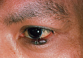 Kaposi's sarcoma on lower eyelid of AIDS patient