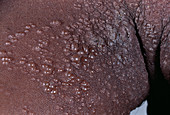 Shingles rash in an AIDS patient