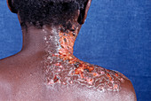 Shingles rash in an AIDS patient