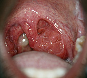 Tonsil hypertrophy