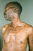 Kaposi's sarcoma skin plaques