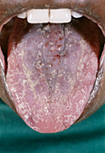 Kaposi's sarcoma of the tongue