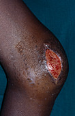 Open wound in AIDS