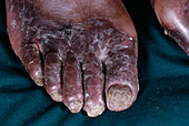 AIDS man with candidiasis