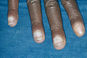 AIDS man with discoloured fingernails