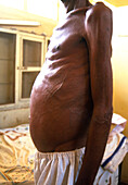 Distended abdomen of a man with schistosomiasis
