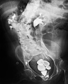 X-ray showing bladder stones
