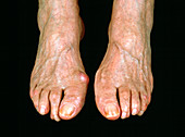 Bunion