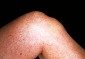 Bursitis of knee