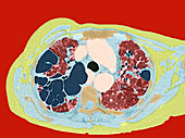 Lung disorder,CT scan