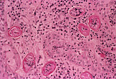 Bilharzia infection,bladder tissue