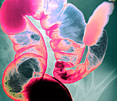 Intestinal parasite,barium X-ray