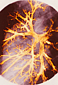 Bronchitis,X-ray