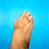 Bunion on a middle-aged man's foot