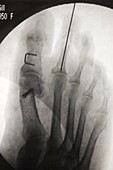 Bunion treatment,X-ray