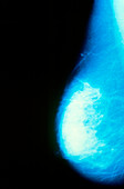 Mammogram of female breast showing cancer