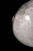 X-ray mammogram showing evidence of breast cancer