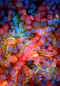 Immunofluorescent LM of breast cancer cells