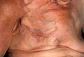Scar after a mastectomy to remove breast cancer