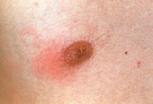 Mastitis causing inflammation of man's nipple