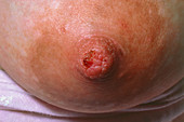 Close-up photo of a cracked female nipple