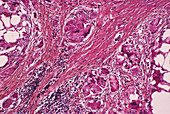 Breast fat cell death