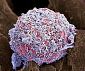 Breast cancer cell,SEM