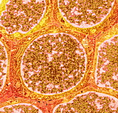 Benign breast disease cells,TEM