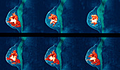 Breast cancer,MRI scans