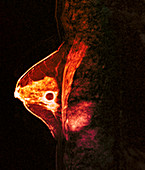 Breast cancer,MRI scan