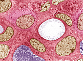 Breast cancer cells,TEM