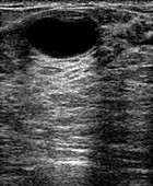Fibrocystic disease,ultrasound scan