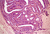 Breast fibroadenoma,light micrograph