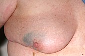Breast cancer test after surgery