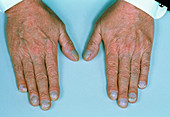 Hands showing cyanosis (Blueing of nail beds)