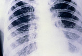 X-ray image of the chest showing cystic fibrosis
