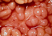 Close-up of small intestine in Crohn's disease