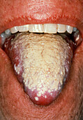 Severe oral candidiasis (thrush) affecting tongue