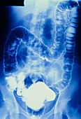 Double-contrast X-ray of ulcerative colitis