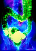 F/col double-contrast X-ray of ulcerative colitis