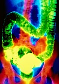 F/col double-contrast X-ray of ulcerative colitis