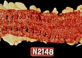 Ulcerative colitis: specimen of gut