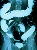 Double-contrast X-ray in Crohn's disease