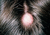 Sebaceous cyst on man's scalp