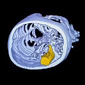 False-colour 3-D CT scan of an arachnoid cyst
