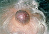 A sebaceous cyst on the head of an elderly woman
