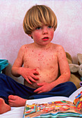 Young boy affected by a severe form of chickenpox