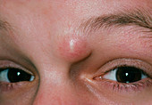 Close-up showing a sebaceous cyst in eyebrow